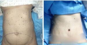 Antes y después de abdominoplastia, cirugía de abdomen