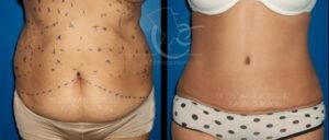 Antes y después de abdominoplastia