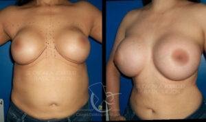 Aumenta tus senos con implantes mamarios