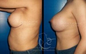 Aumento de mamas y reducción de abdomen con liposucción